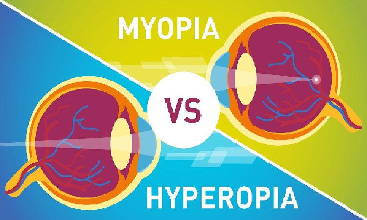 hyperopia and myopia hyperopia and myopia