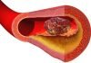 pooping blood clot