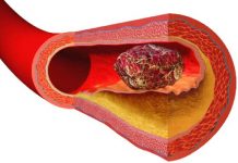 What causes a pooping blood clot pooping blood clot