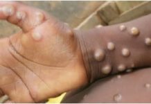 Monkeypox | What is Monkeypox and symptoms Monkeypox