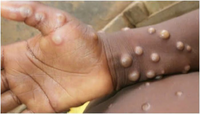 Monkeypox Monkeypox