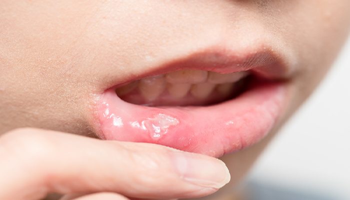 canker sores canker sores