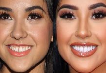 Becky g teeth – Becky g teeth before and after Becky g teeth